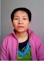 '图4:姜晓艳整齐的牙齿全部稀松、离缝。'