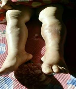 '康爱芬被迫害得全身浮肿,双腿不能站立行走。'