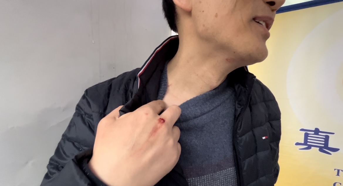 图3:法轮功学员David Fang于二月十六日下午,遭齐中平暴力攻击,导致流血,手背、脖子、下巴都有伤痕。(法轮功学员提供)