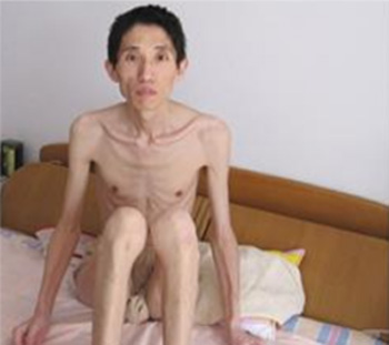 图:高宏被劳教所摧残致骨瘦如柴。