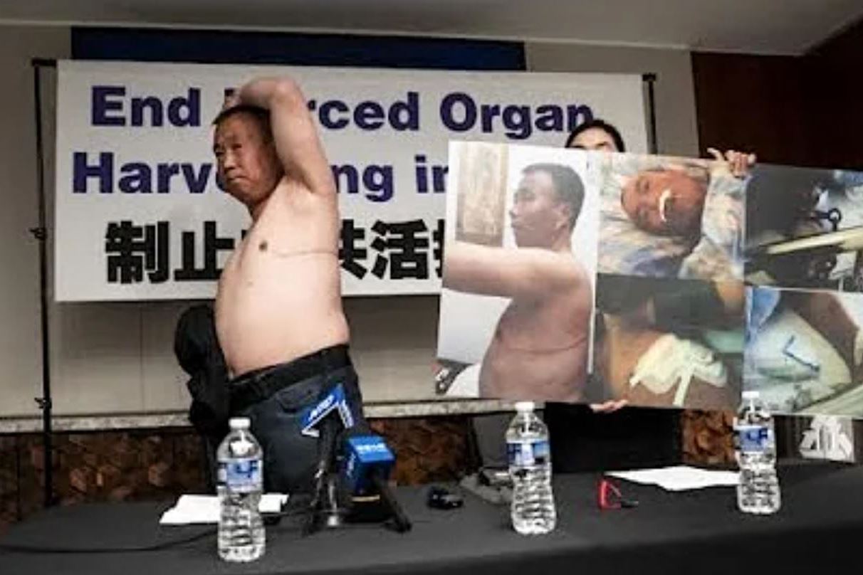 '图:二零二四年七月三日,法轮功学员程佩明现身美国华府,公开讲述自己从中共活摘器官罪恶中幸存、最后逃脱的经历。图为程佩明在现场展示,第一次活摘器官手术在其身体留下的一条长达35厘米的疤痕。(NTD视频截图)'