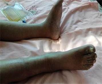 '出狱时下肢皮肤都是坏死的,呈黑色的'